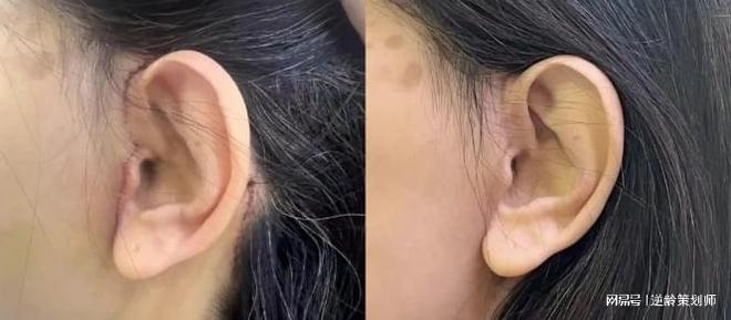 下颌缘提升怎么做才自然？袁强博士男性拉皮案例推荐专家整形